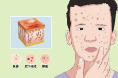 眉毛长痘痘是什么原因